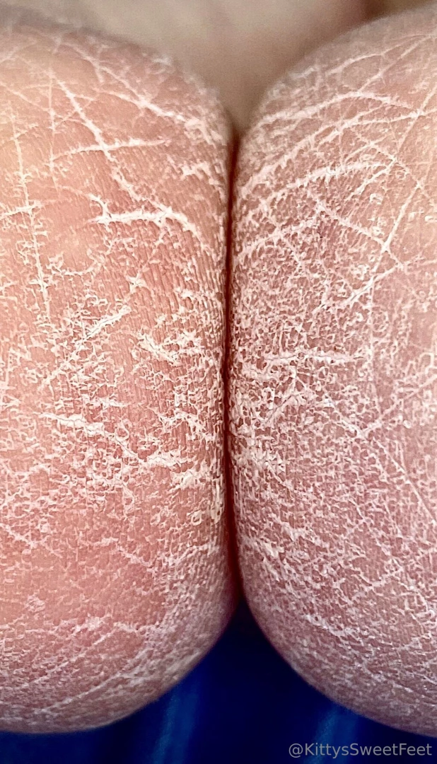 Dry cracked heels set of 23 sent to your dm new fans if you ve 