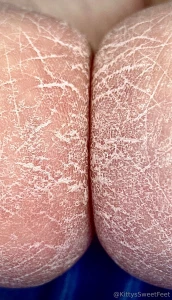 Dry cracked heels set of 23 sent to your dm new fans if you ve