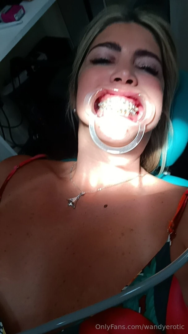 Today i m getting another brace ask me for more 