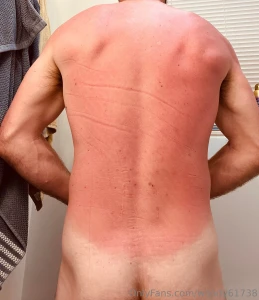 Welcome to summer the burn has started i need lotion send tips part 1