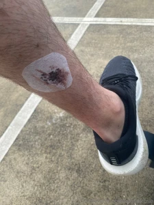 Sorry i ve been quiet for a while doctors have had fun carving a few