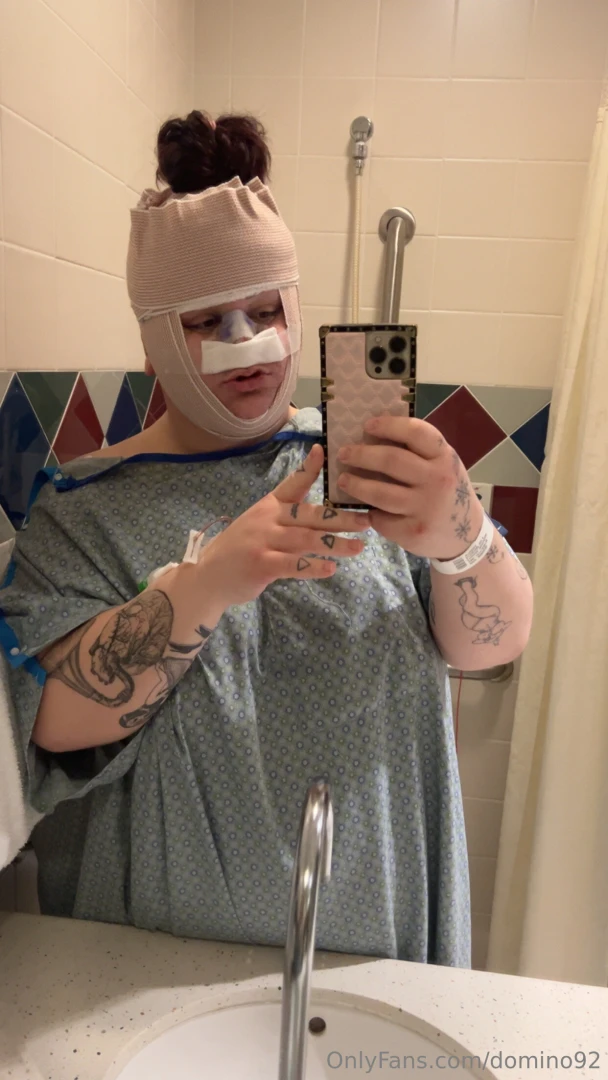 Well i got my ffs done can t wait to see the results any and all tips 