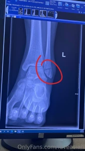 Sorry for not being as active lately i went to the er the other night