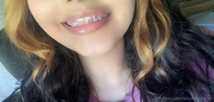 Meh braces
