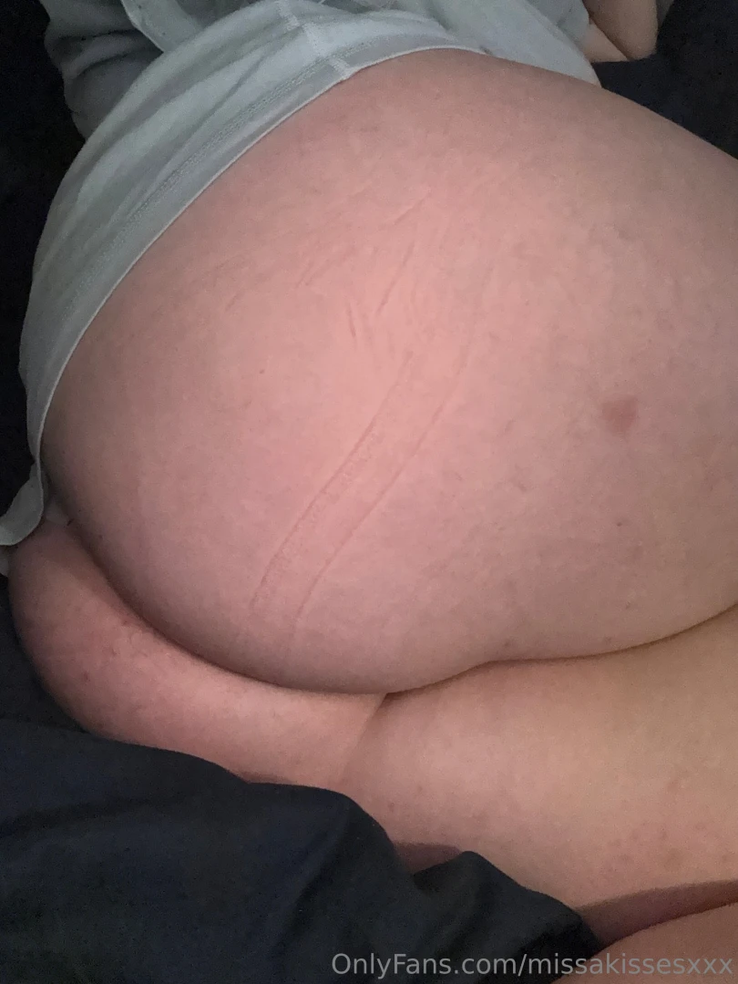 Look at that bug bite lol 