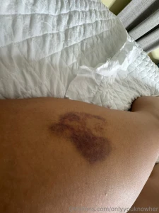 I bruise like a peach