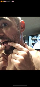 Biggest cyst i ve ever drained i once had an oral surgeon cut