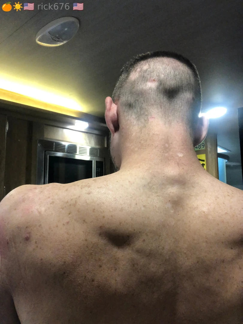 I fell and hit my head badly in 2018 i am trying to pass a bar exam 