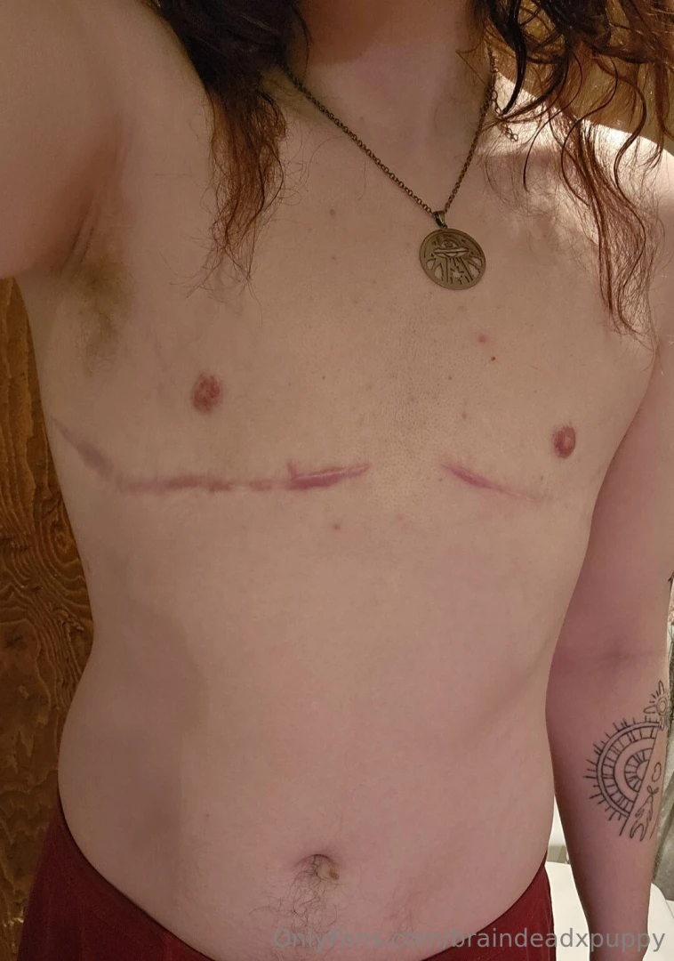 It s been 10 months since my top surgery part 1 