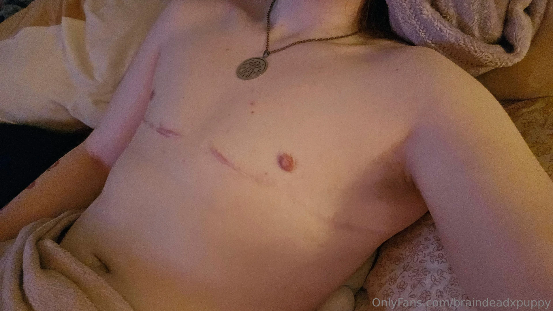 It s been 10 months since my top surgery 