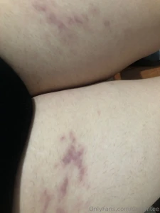 Hola amorcitos les cuento que tuve una reacci n al rgica y en esta