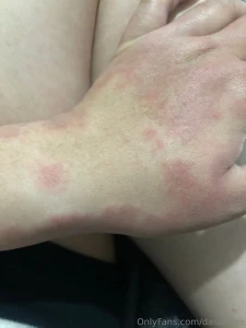 Hola amorcitos les cuento que tuve una reacci n al rgica y en esta part 1