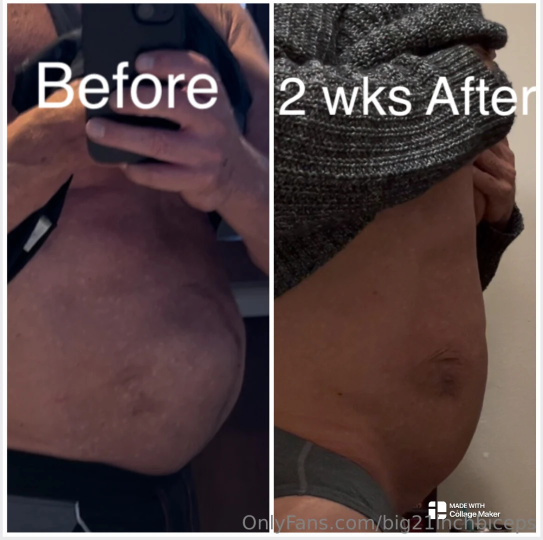 Progress after my hernia surgery 2 weeks ago 