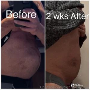 Progress after my hernia surgery 2 weeks ago