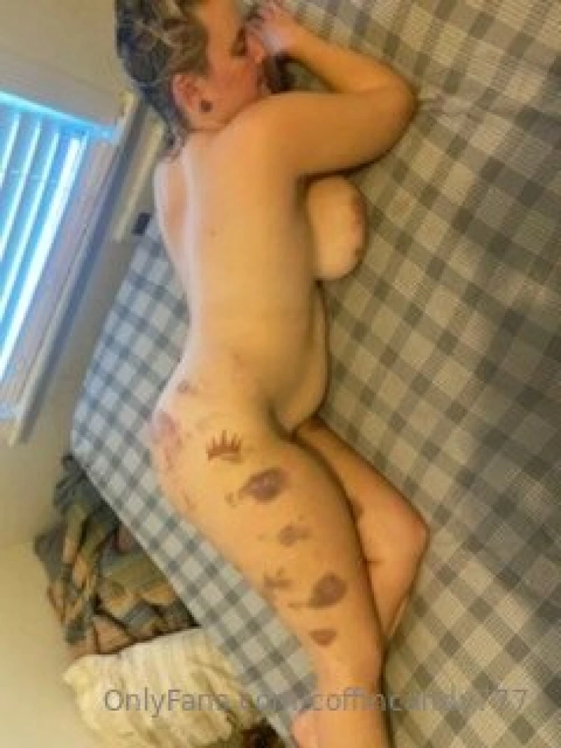 Day two bruises aren t they pretty part 1 