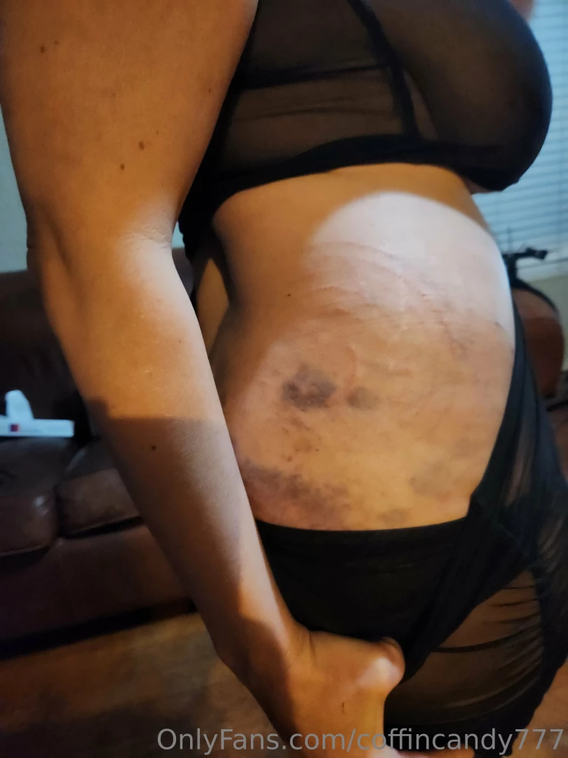 How do you like my day two bruises after a big impact scene friday 