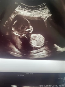 Im 17 weeks today i will post an update soon sorry for not being very