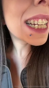 Ho finalmente tolto l apparecchio e fare ancora di pi la porcona con