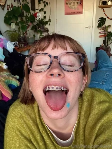 Braces on 3