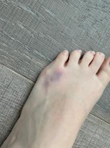 I got a hella foot owie today - kiss it and make it better