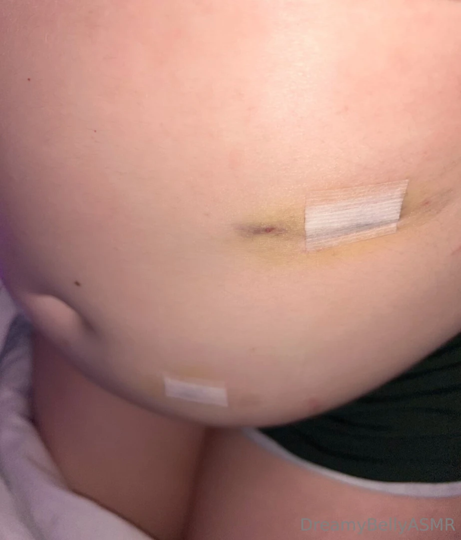 Good afternoon my wonderful darlings surgery went well but my belly part 2 