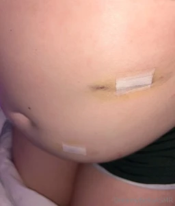 Good afternoon my wonderful darlings surgery went well but my belly part 2