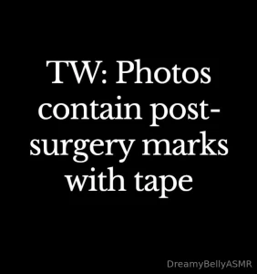Good afternoon my wonderful darlings surgery went well but my belly part 1