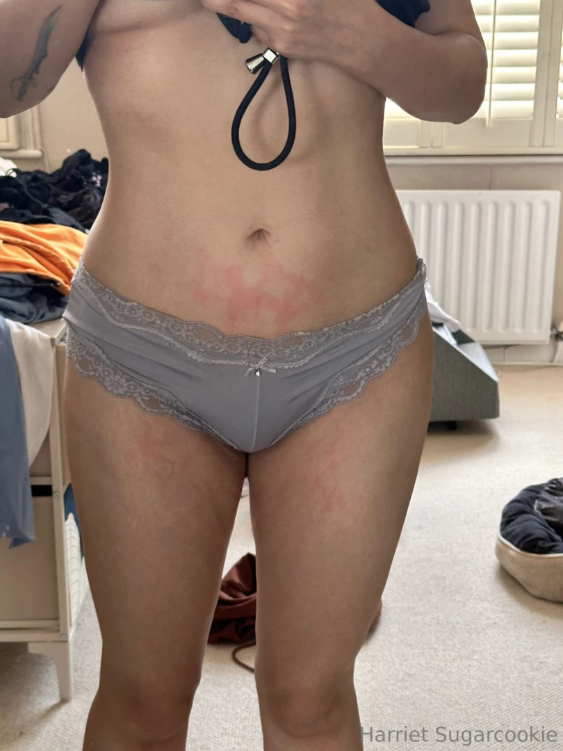 Burnt myself today by accident i swear if i could get a dollar for 