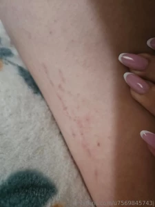 Yesterday i saw new stretch marks on myself