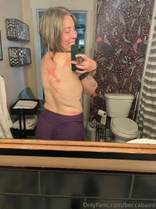 Send help i clearly need some sunscreen assistance and now some aloe