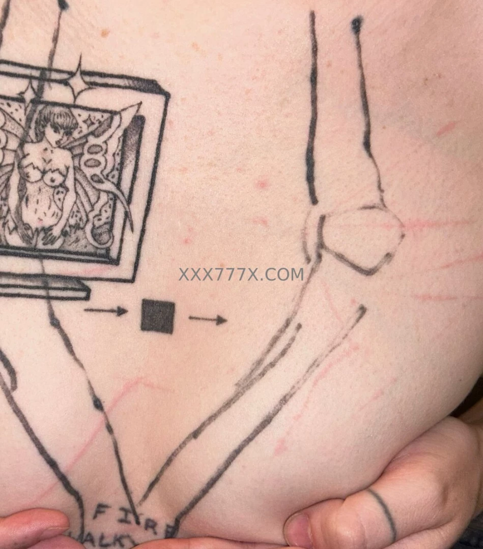 Aftermath of my latest needle play video part 7 