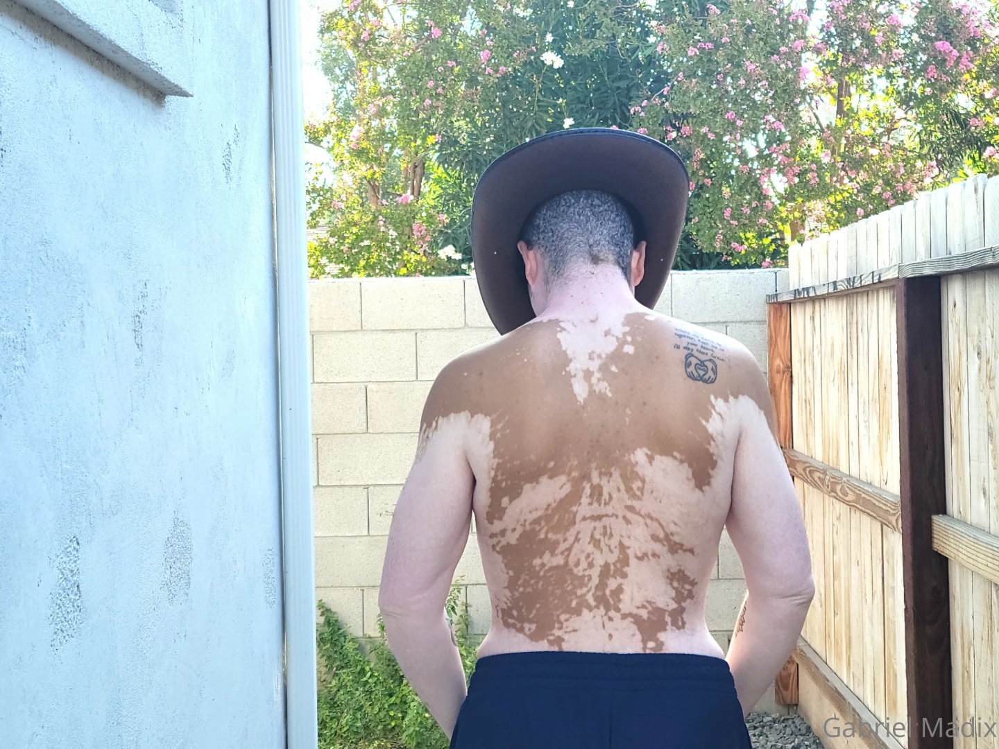 Vitiligo backshots sunday part 1 