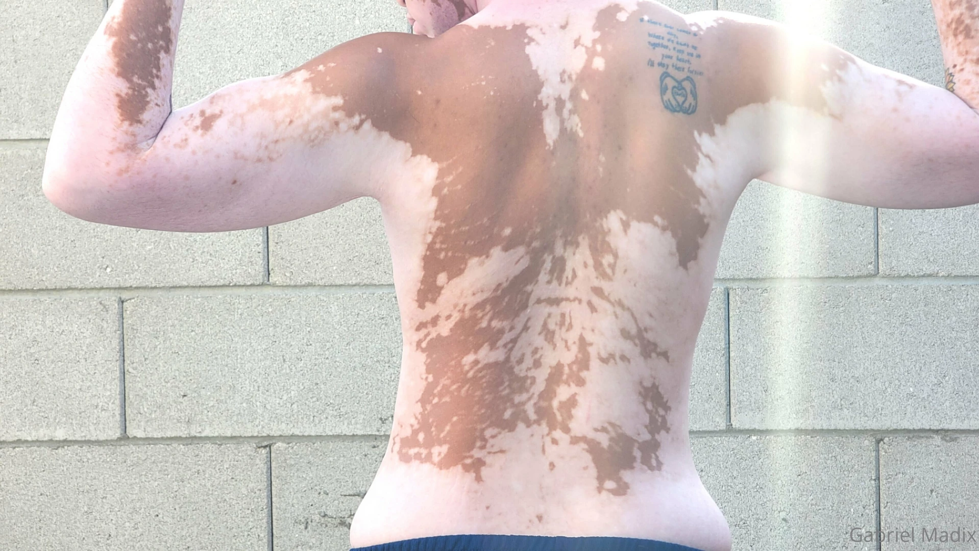 Vitiligo backshots sunday 