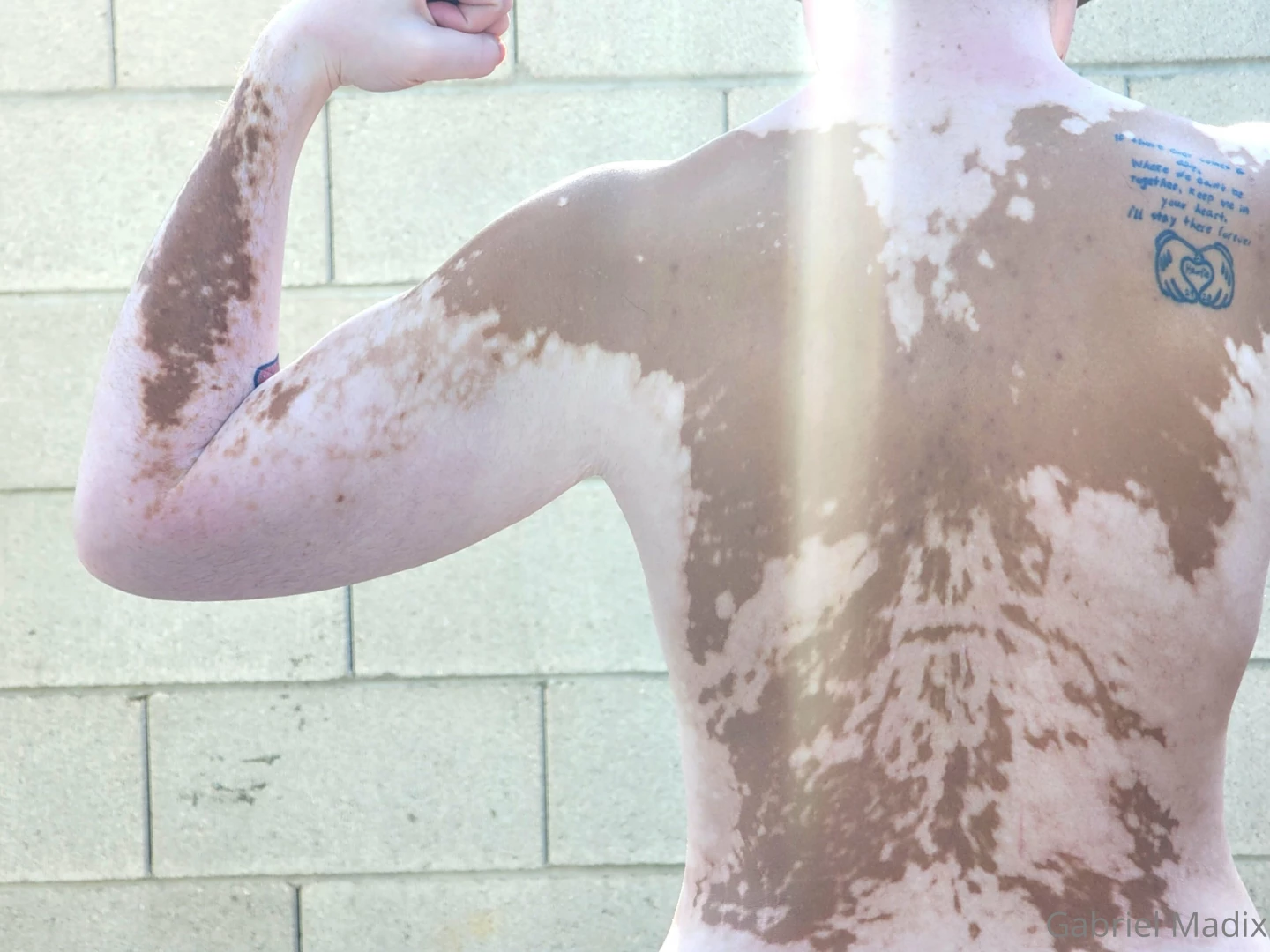 Vitiligo backshots sunday part 6 