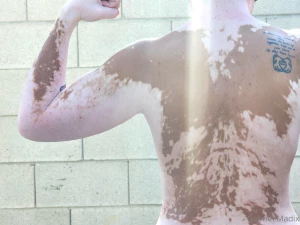 Vitiligo backshots sunday part 6