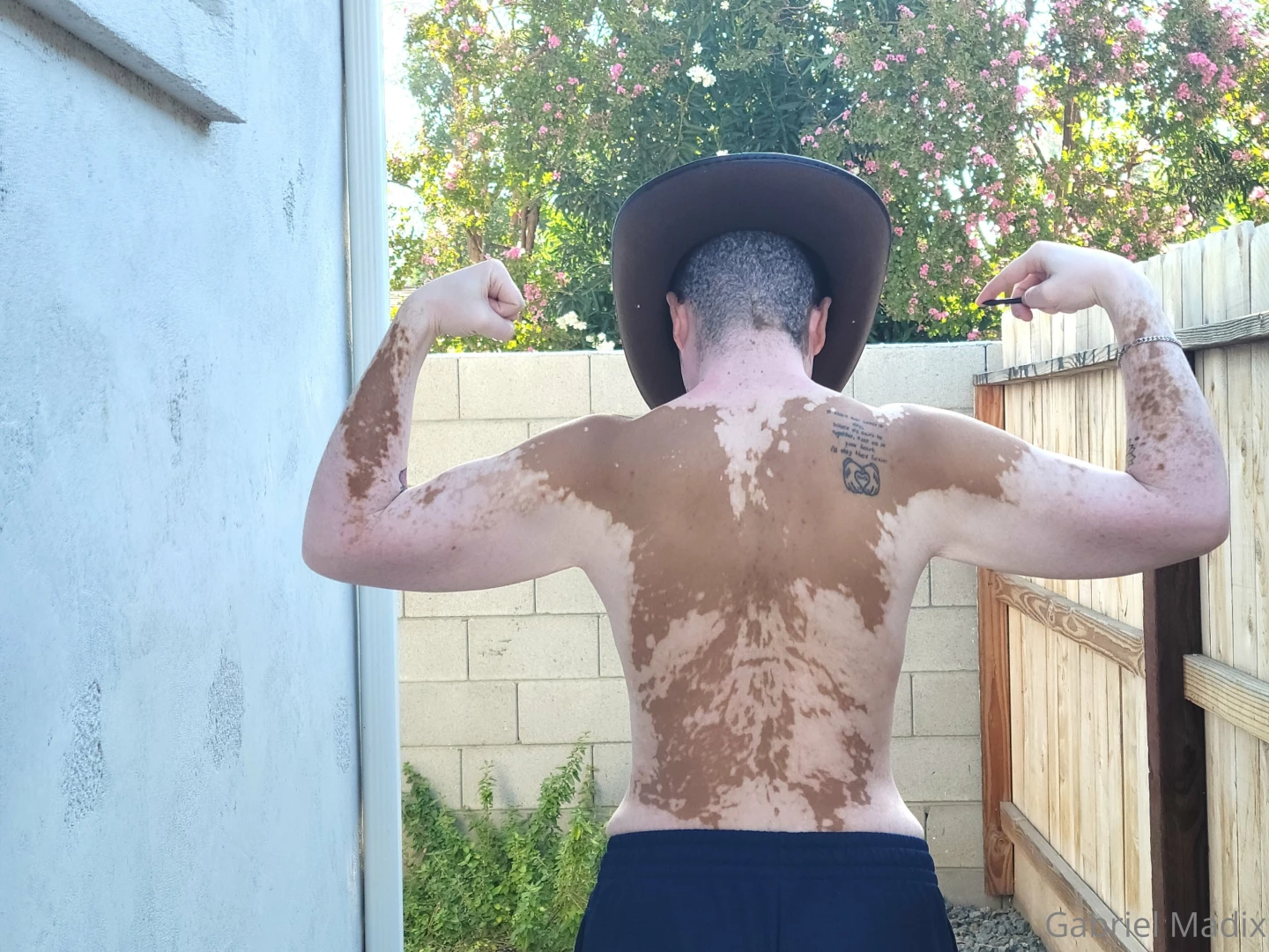 Vitiligo backshots sunday part 5 