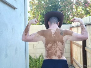 Vitiligo backshots sunday part 5
