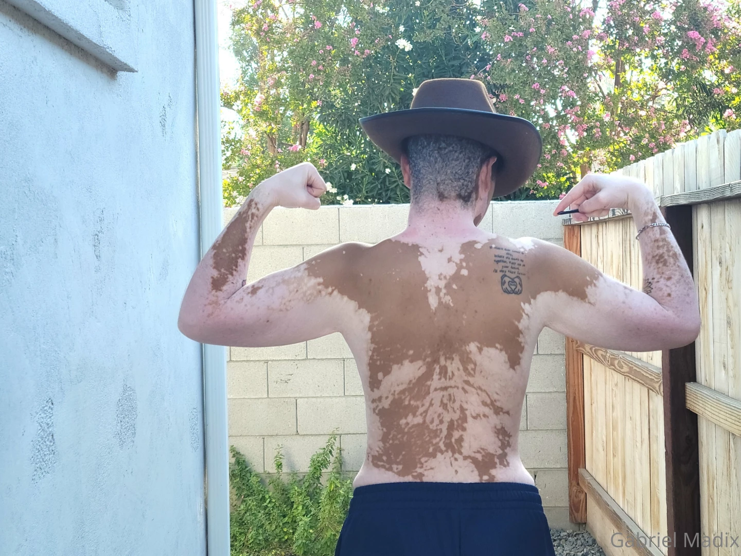 Vitiligo backshots sunday part 2 
