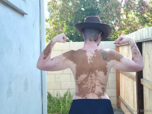 Vitiligo backshots sunday part 2