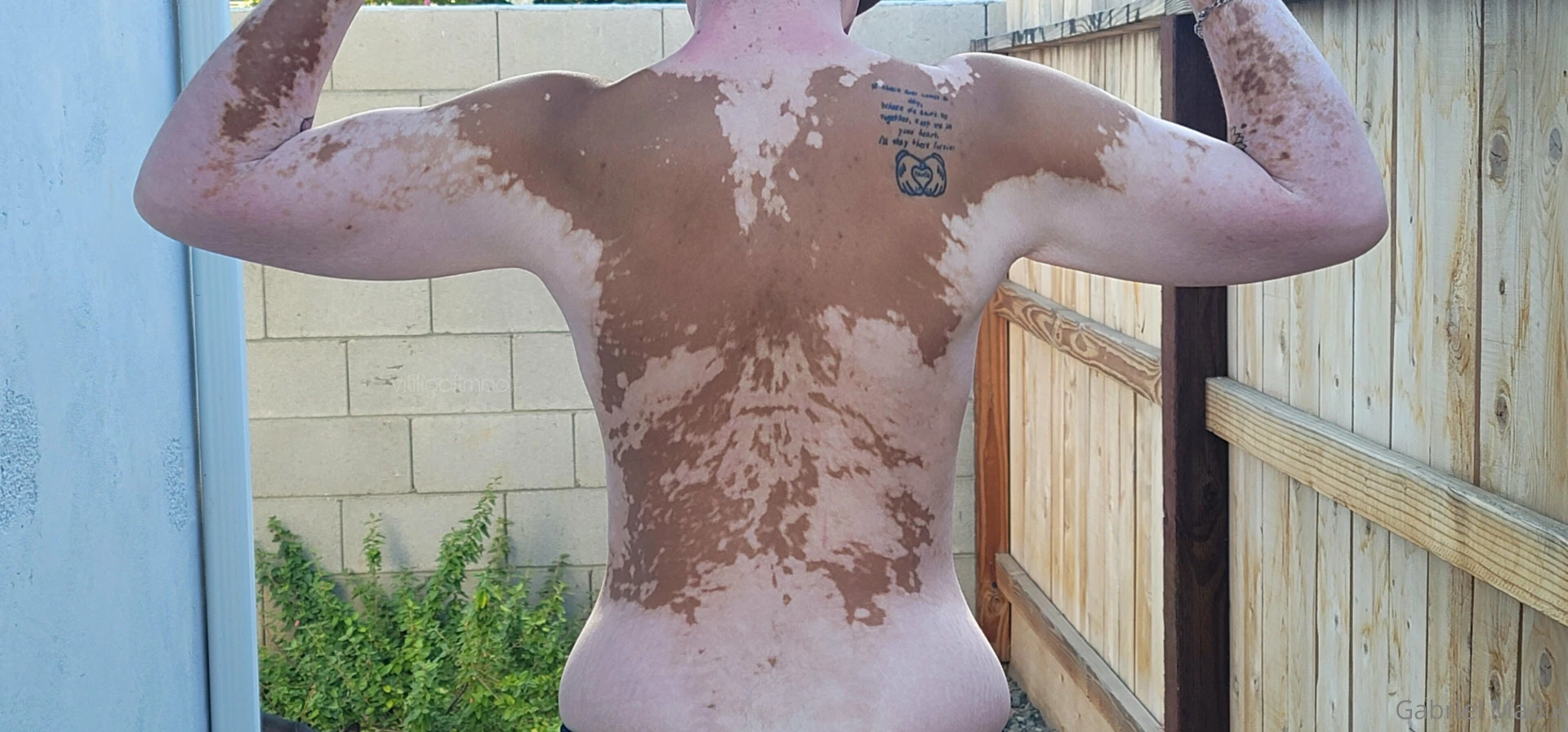 Vitiligo backshots sunday part 3 