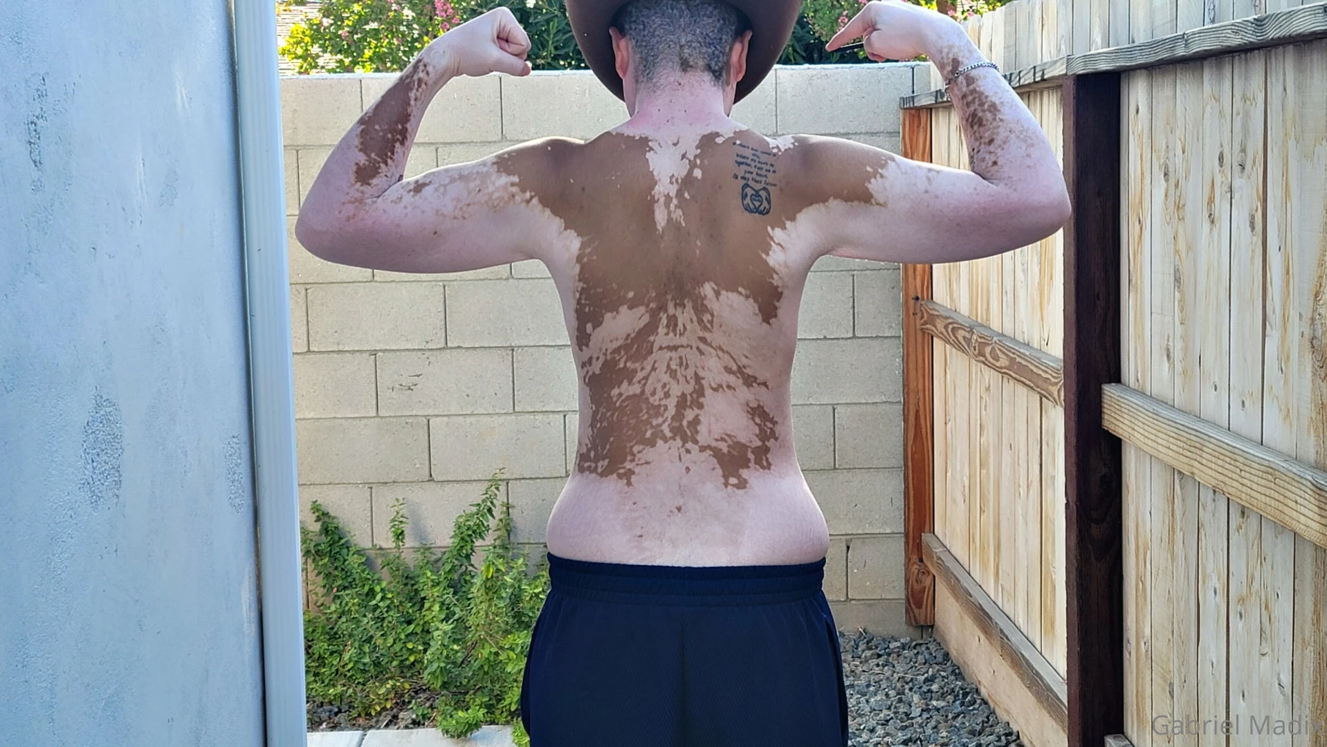 Vitiligo backshots sunday part 4 