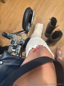 I broke my ankle im stuck on a cast for 8 more weeks uber driver did