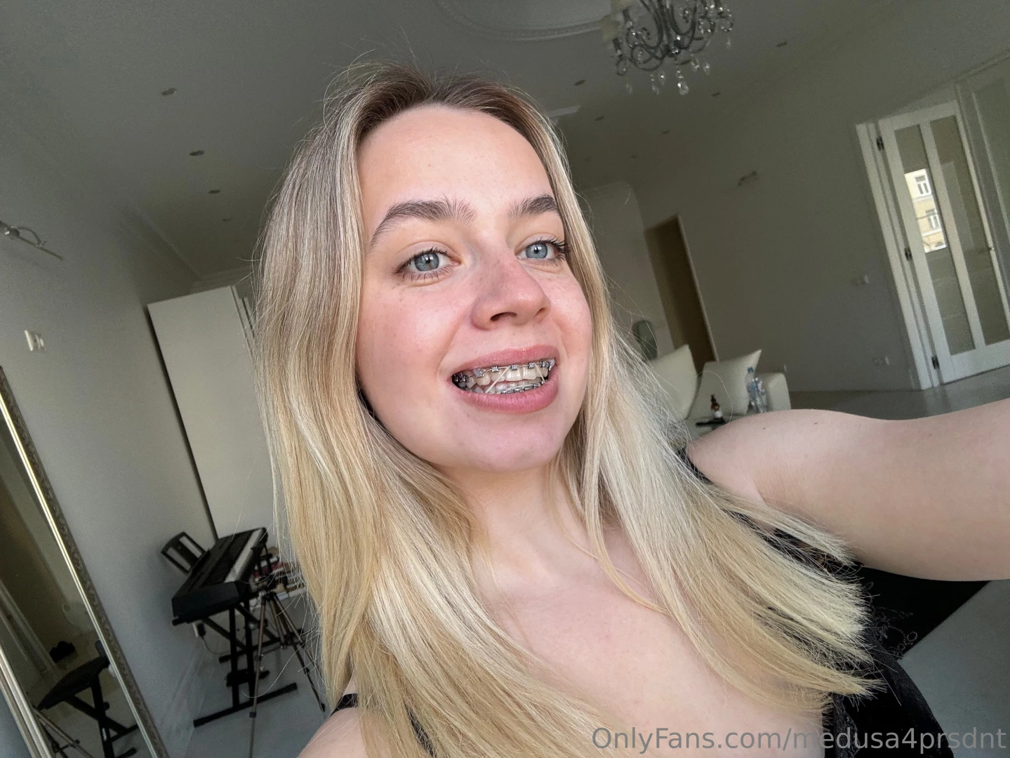 Rate my braces part 1 