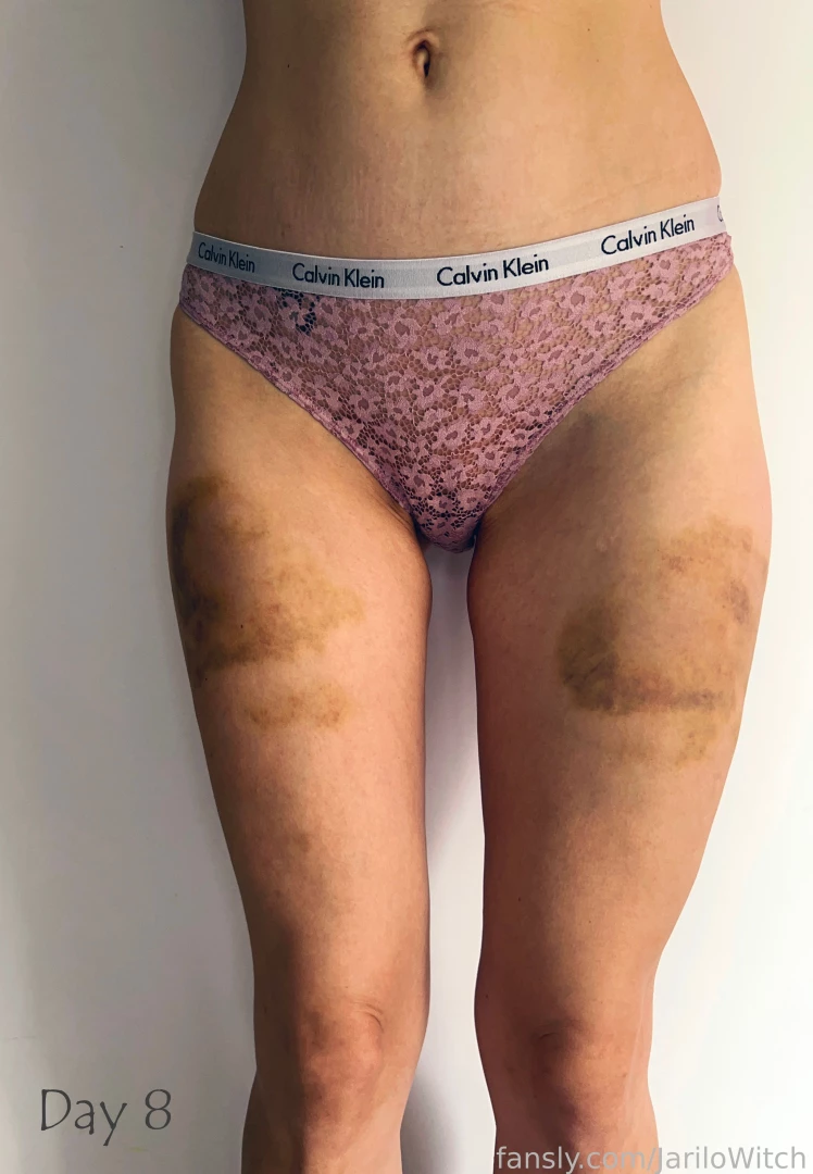 I got a serious can1ng two weeks ago since then i documented the part 1 