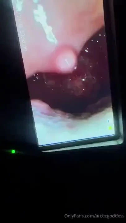 Thank you for funding my endoscope i appreciate you all so very much 