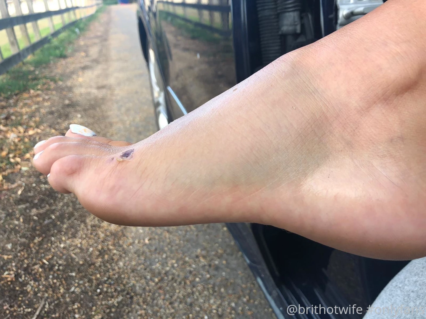 Foots so painful and swollen after i was attacked by a neighbour part 2 