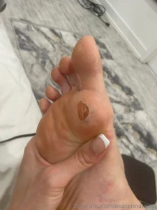 How long do you think it will take to heal this is from the black part 1