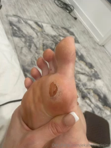 How long do you think it will take to heal this is from the black part 3