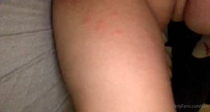 jokaphotos - I got an allergic reaction to some pills and have red bumps everywhere 