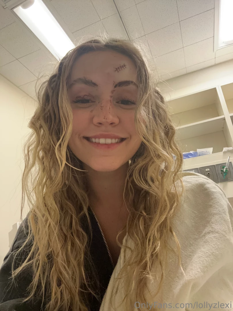 Took a little tumble the other night but smiling through the pain 